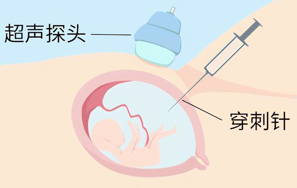 孕期做羊水穿刺的时间