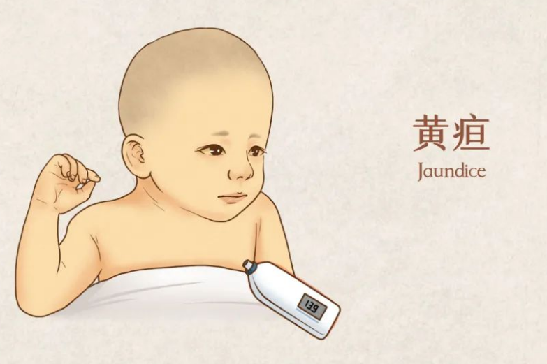 手脚不黄不一定是生理性黄疸