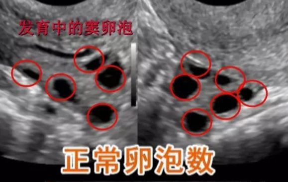 双侧卵泡正常数量