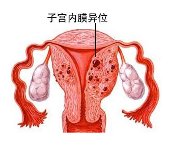 内膜异位06.jpg