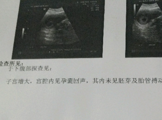 检查显示宫内未见孕囊