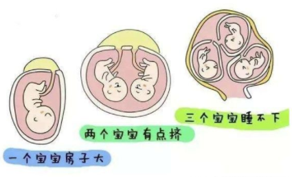试管三胎减胎