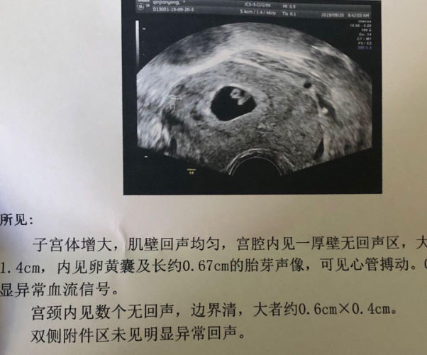 一超有胎心也可能发生胎停