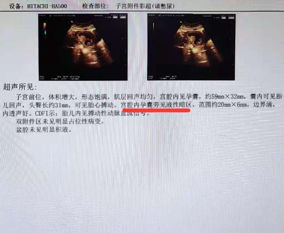 孕期宫腔积液可能是疾病引起