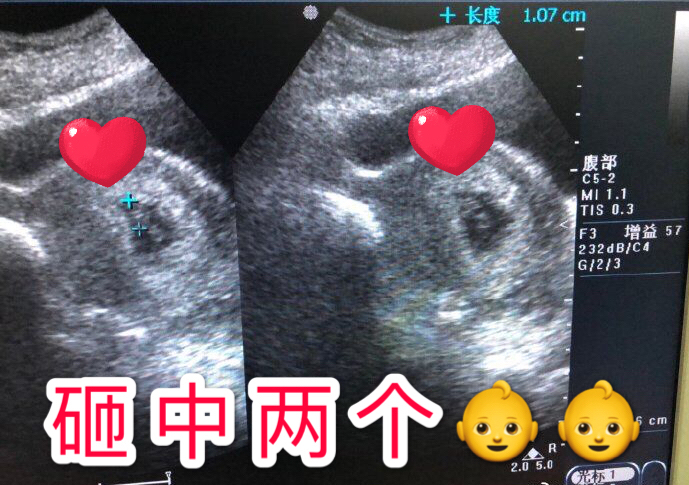 试管婴儿图片