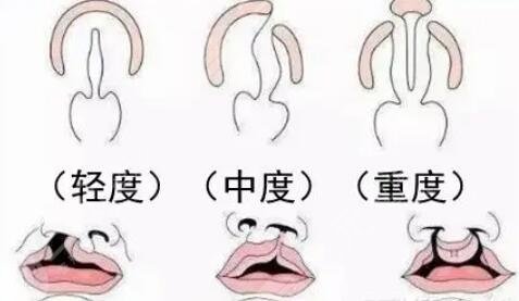 唇腭裂做三代试管能降低几率