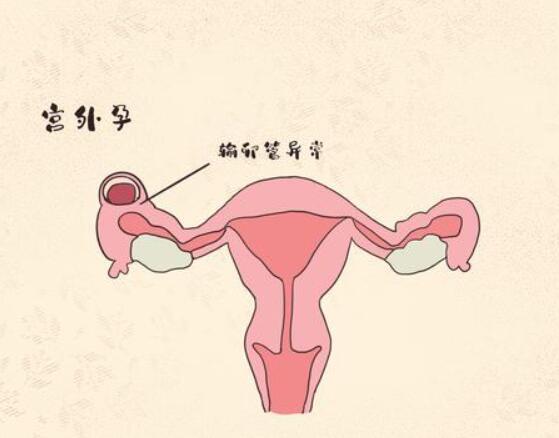 移植冻胚不一定是宫外孕