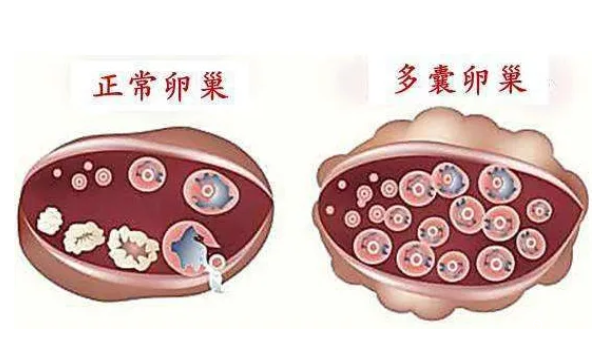 多囊卵巢的易患人群