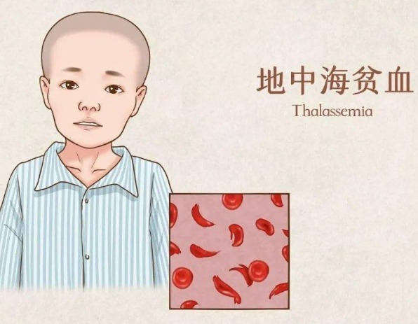 地贫夫妻做试管要了解费用