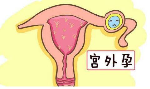 什么是宫外孕