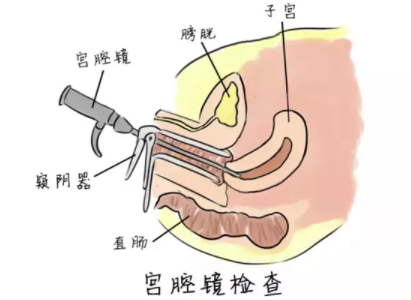 宫腔镜检查卵巢疾病