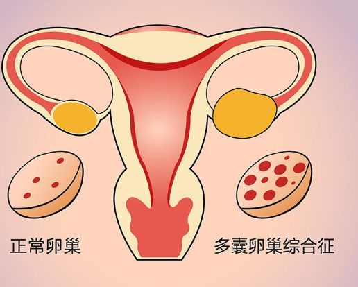 多囊会导致不孕