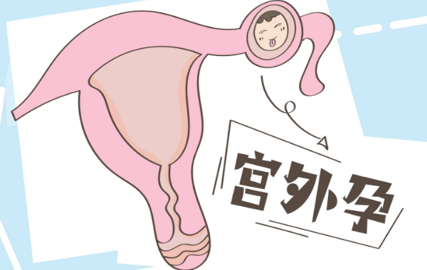宫外孕影响第二次怀孕