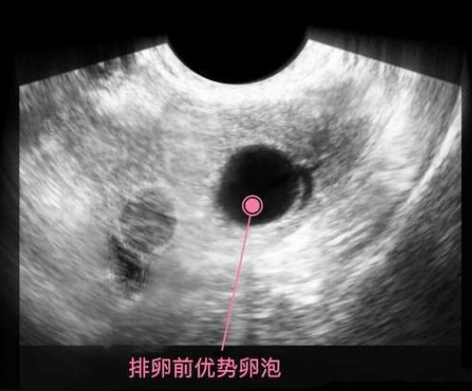 优势卵泡一个月只有一个