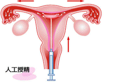 人工授精.jpg