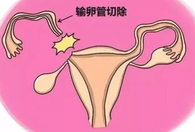 输卵管切除术后会不会宫外孕