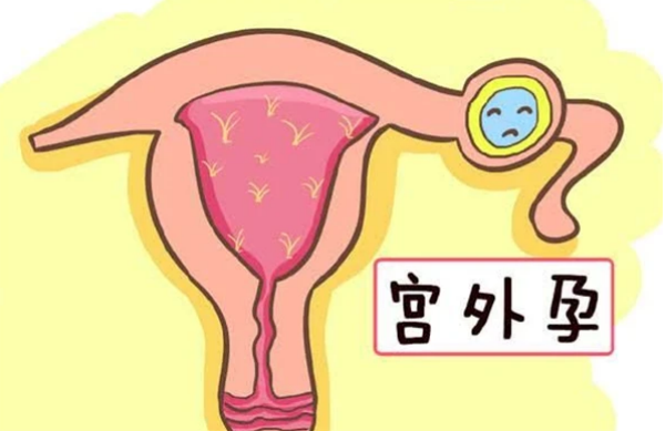 没有出血也有宫外孕