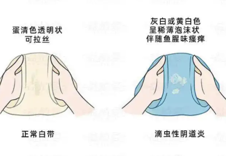 白带异常是什么症状1.png