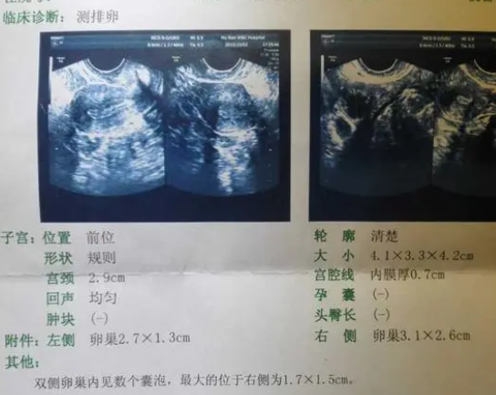 卵泡消失可能是排卵了