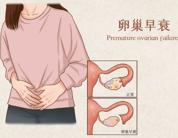 卵巢早衰能做试管