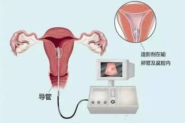 不孕不育做输卵管造影的流程