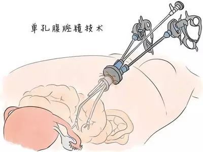 腹腔镜手术到底是怎么做的?手术后伤口多久恢复?