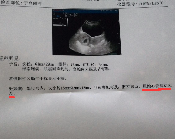 囊胚着床后无胎心的原因多种
