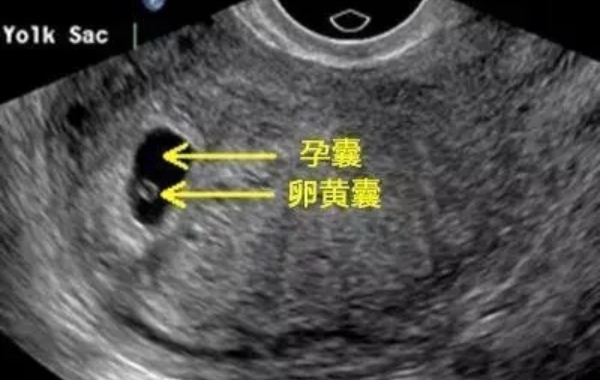 宝宝是男是女是由基因决定的