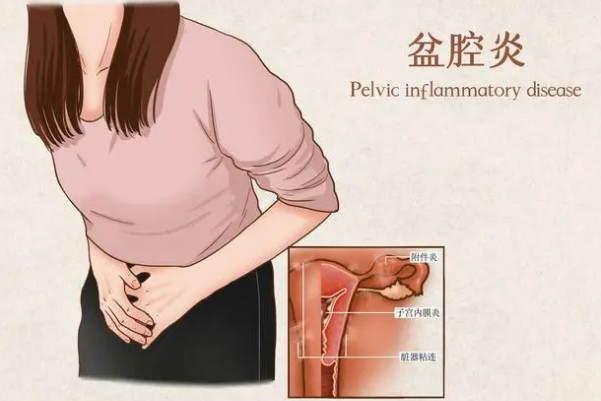 盆腔炎会导致腹痛