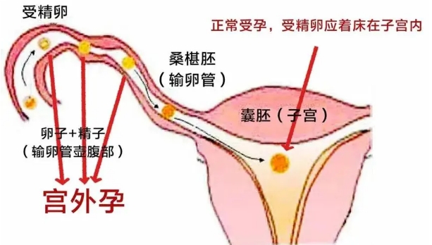 多次宫外孕做试管的成功率