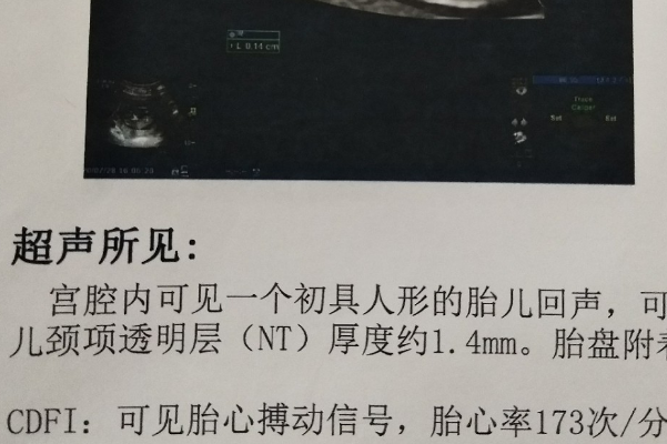 染色体异常造成nt结果不正常