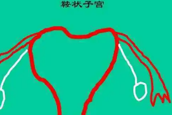 鞍形子宫可以做二代试管