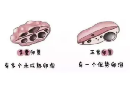 多囊性卵巢症候群1.png