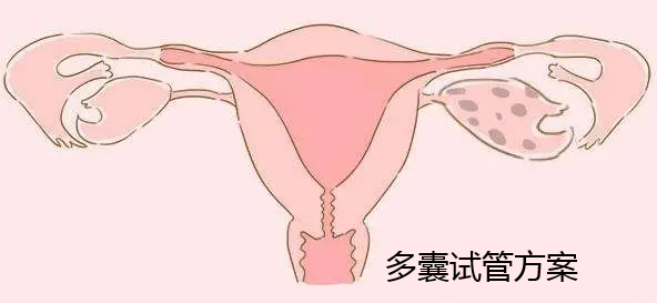多囊试管方案.png