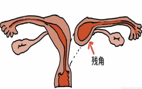 残角子宫畸形