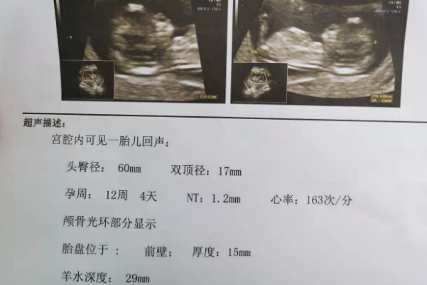 遗传病会导致NT增厚