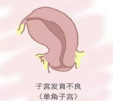 单角子宫