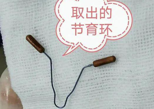 刚取出的节育环