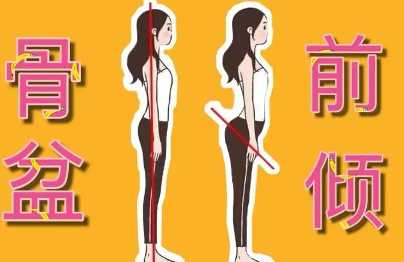 骨盆前倾没有最佳矫正时间