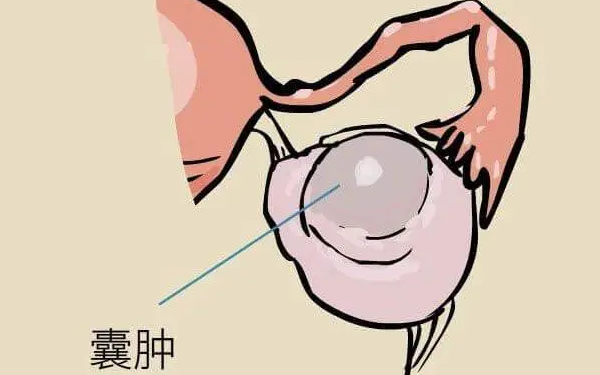 病理性卵巢囊肿是否手术