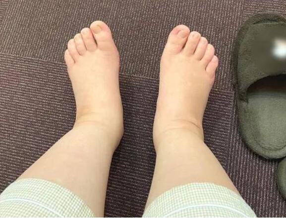 促排药会引起水肿