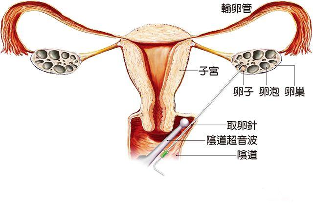 试管婴儿相关图片