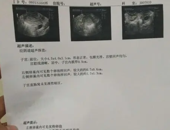 排卵监测能决定移植时机