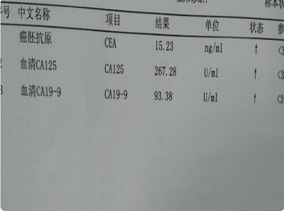 ca125高会影响<a href=