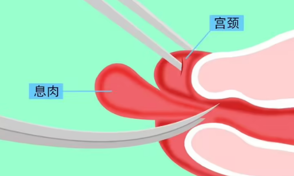 宫颈息肉又怀孕的处理