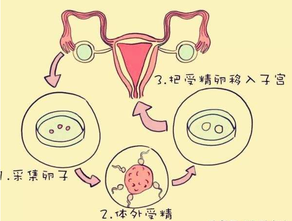 试管婴儿技术的特点及原理.png