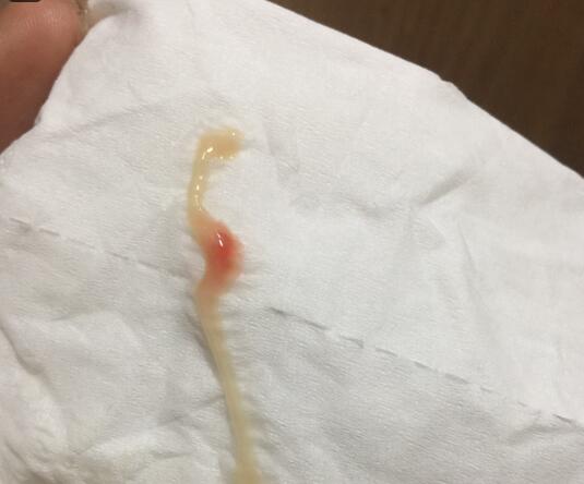 胚胎着床失败会导致内膜脱落