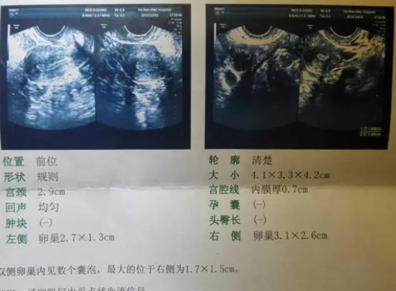 左右卵巢都有小卵泡是正常的