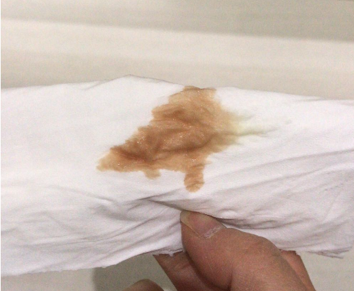 孕初期会出现着床褐色血