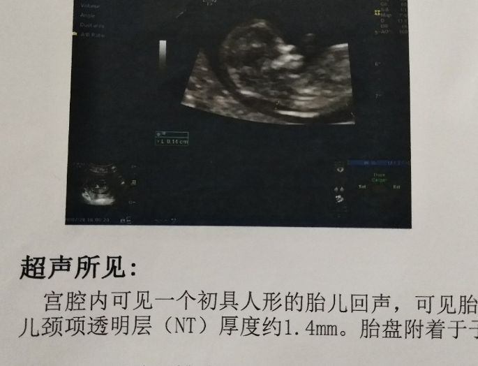 nt检查的厚度不能代表胎儿是男是女